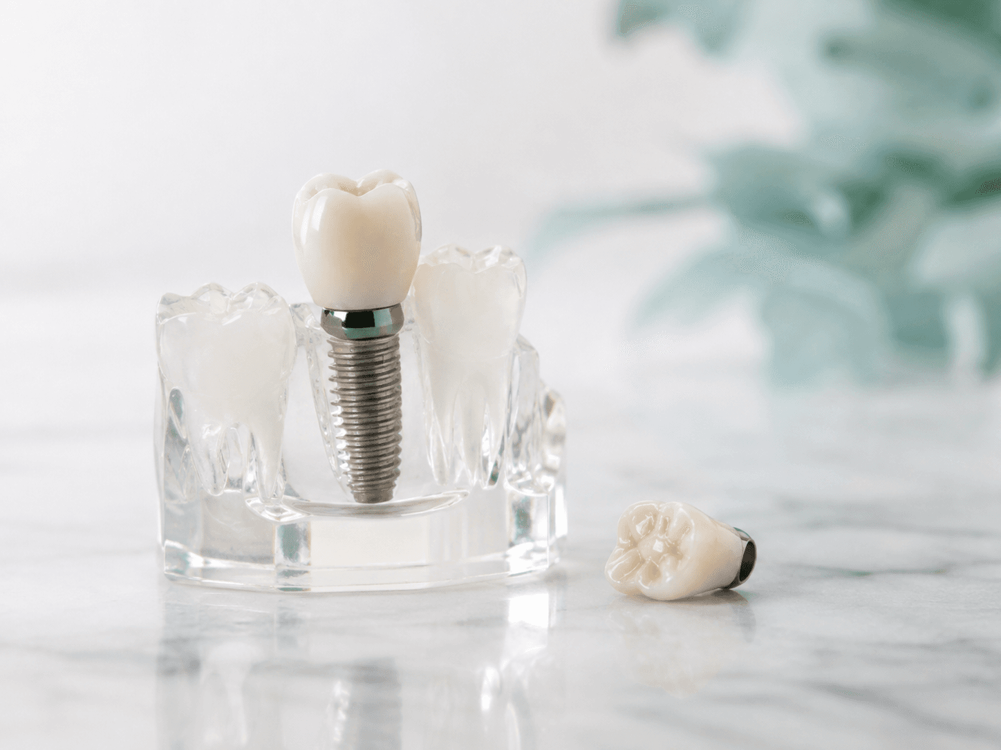 Placeholder for a future consented implant case